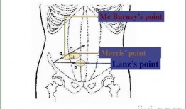 阑尾炎的疼痛位置图片(阑尾炎的疼痛位置图片 症状)